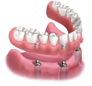 Removable Snap-in Dentures