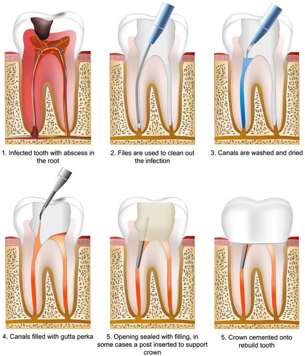 how long does a canine root canal take